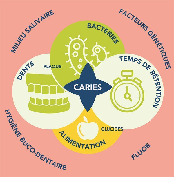 Facteurs caries